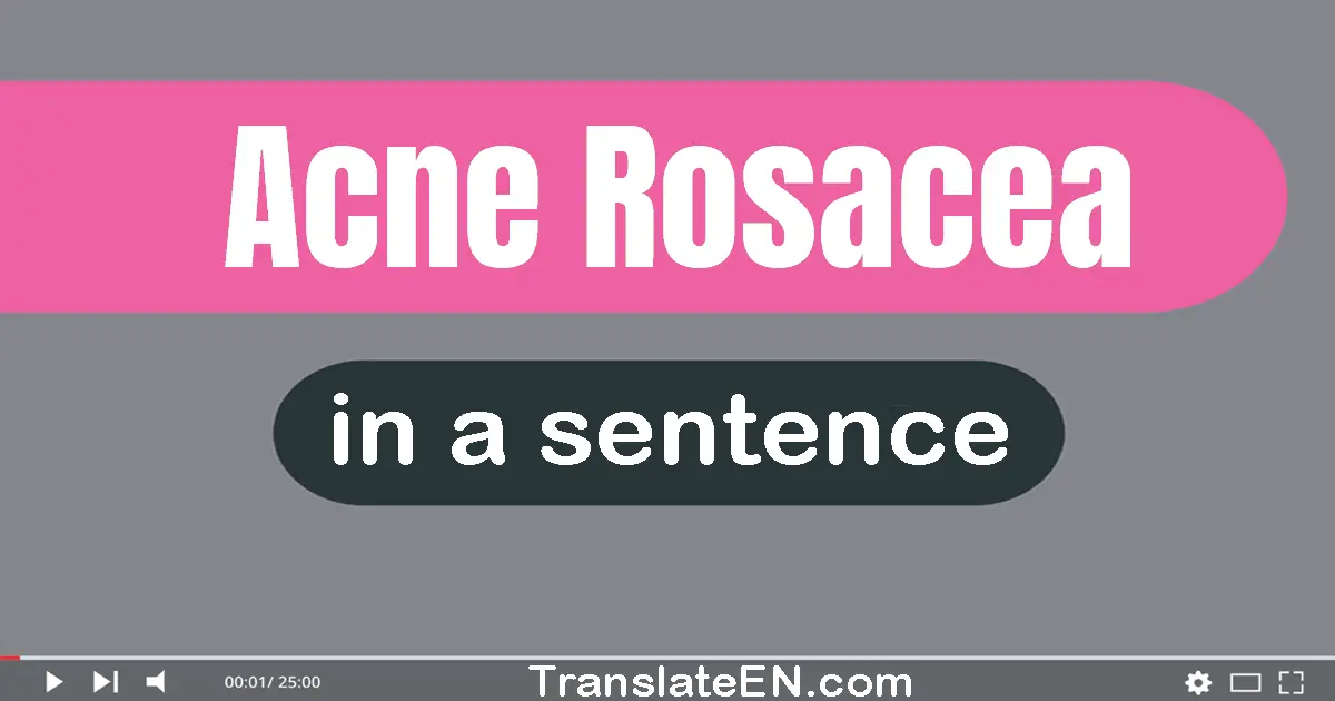 Acne Rosacea in a sentence