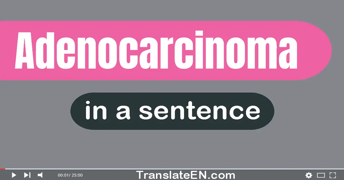 Adenocarcinoma in a sentence