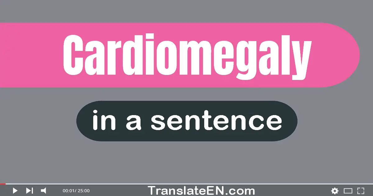 Use "cardiomegaly" in a sentence | "cardiomegaly" sentence examples