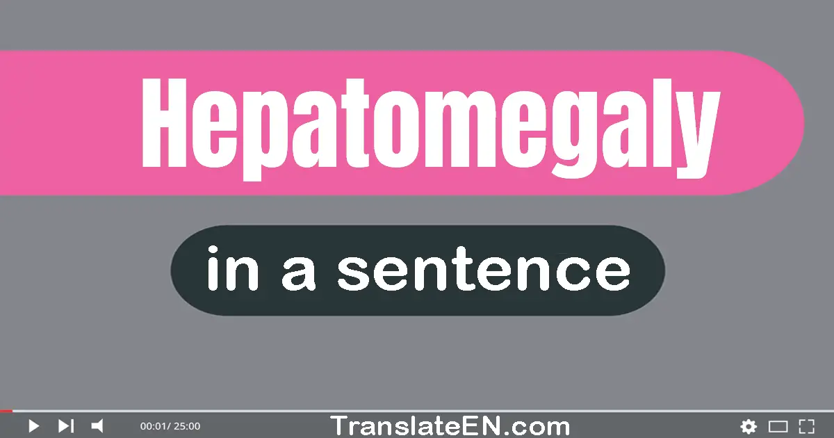 Hepatomegaly in a sentence