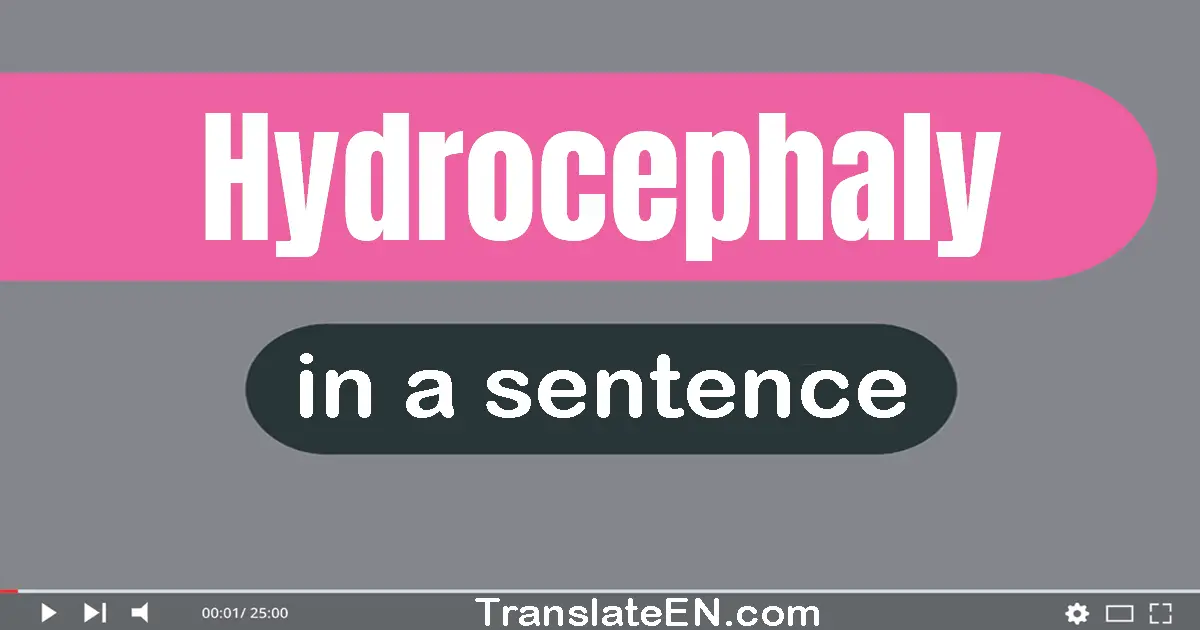 Hydrocephaly in a sentence