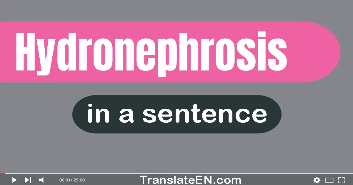 Use "hydronephrosis" in a sentence | "hydronephrosis" sentence examples