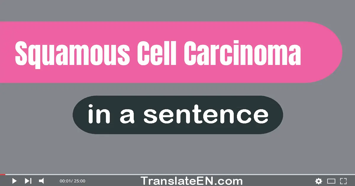 Squamous Cell Carcinoma in a sentence