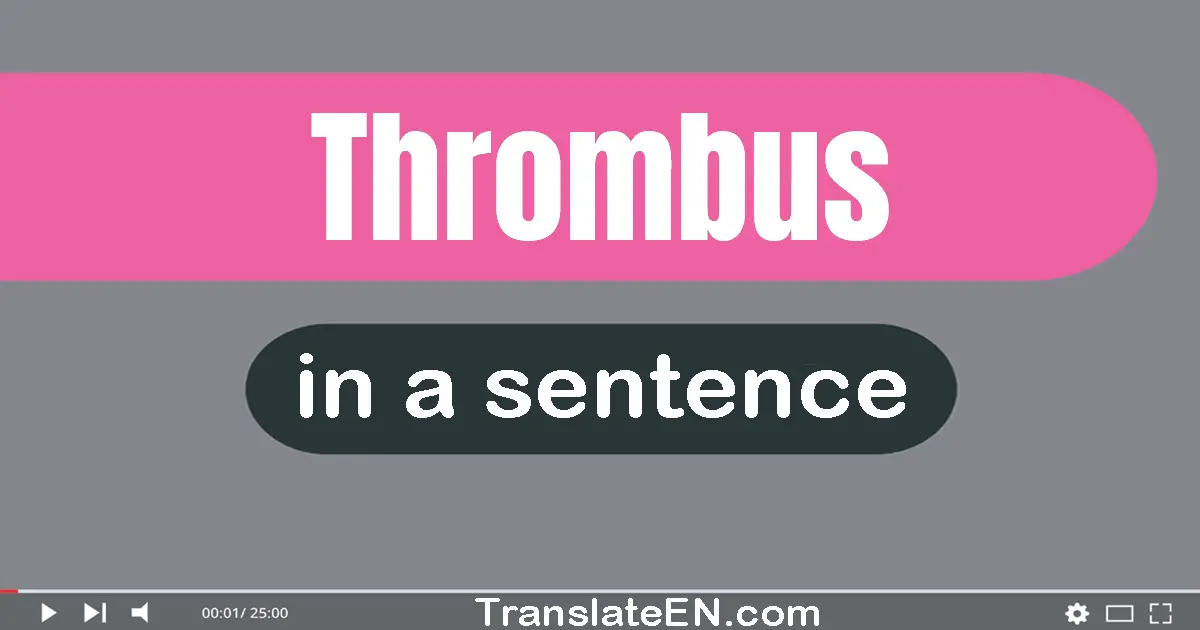 Thrombus in a sentence